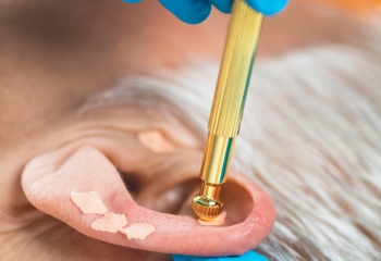 Pérdida de peso y reducción de ansiedad con auriculoterapia en Salamanca